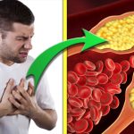Vliv cholesterolu na cévy a srdce: ucpaná tepna a bolest na hrudi.