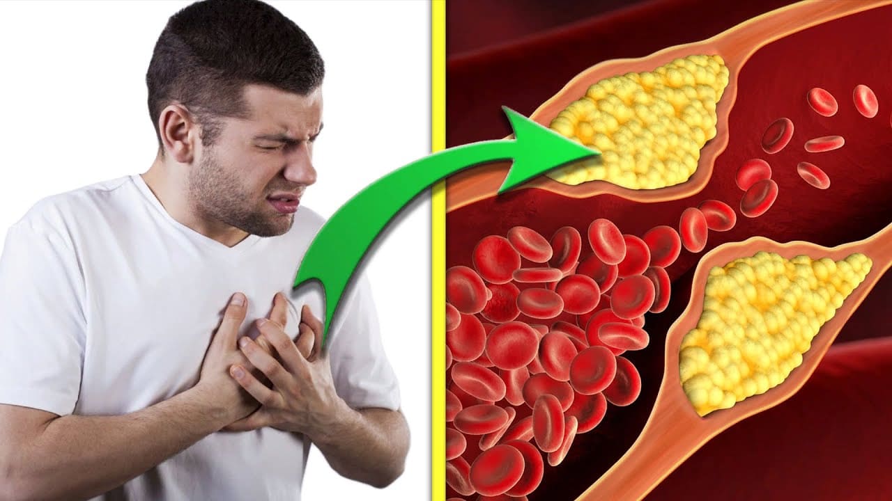 Vliv cholesterolu na cévy a srdce: ucpaná tepna a bolest na hrudi.